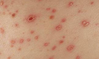 艾滋皮肤初期症状图片,识别与预防的关键